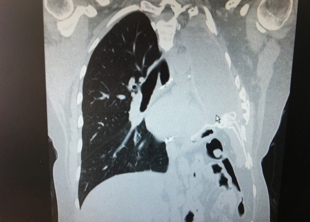 first signs of asbestos exposure