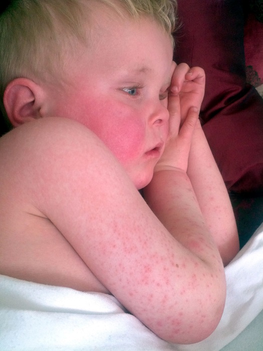 Highly Contagious Scarlet Fever Outbreak Rises to 10-Year High in UK