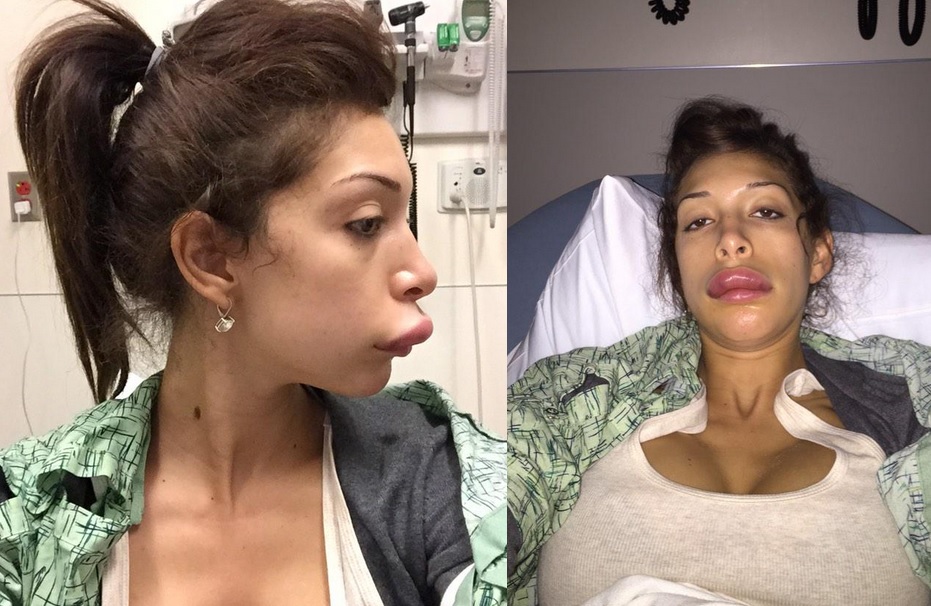 What Happened To Farrah Abrahams Lips Teen M