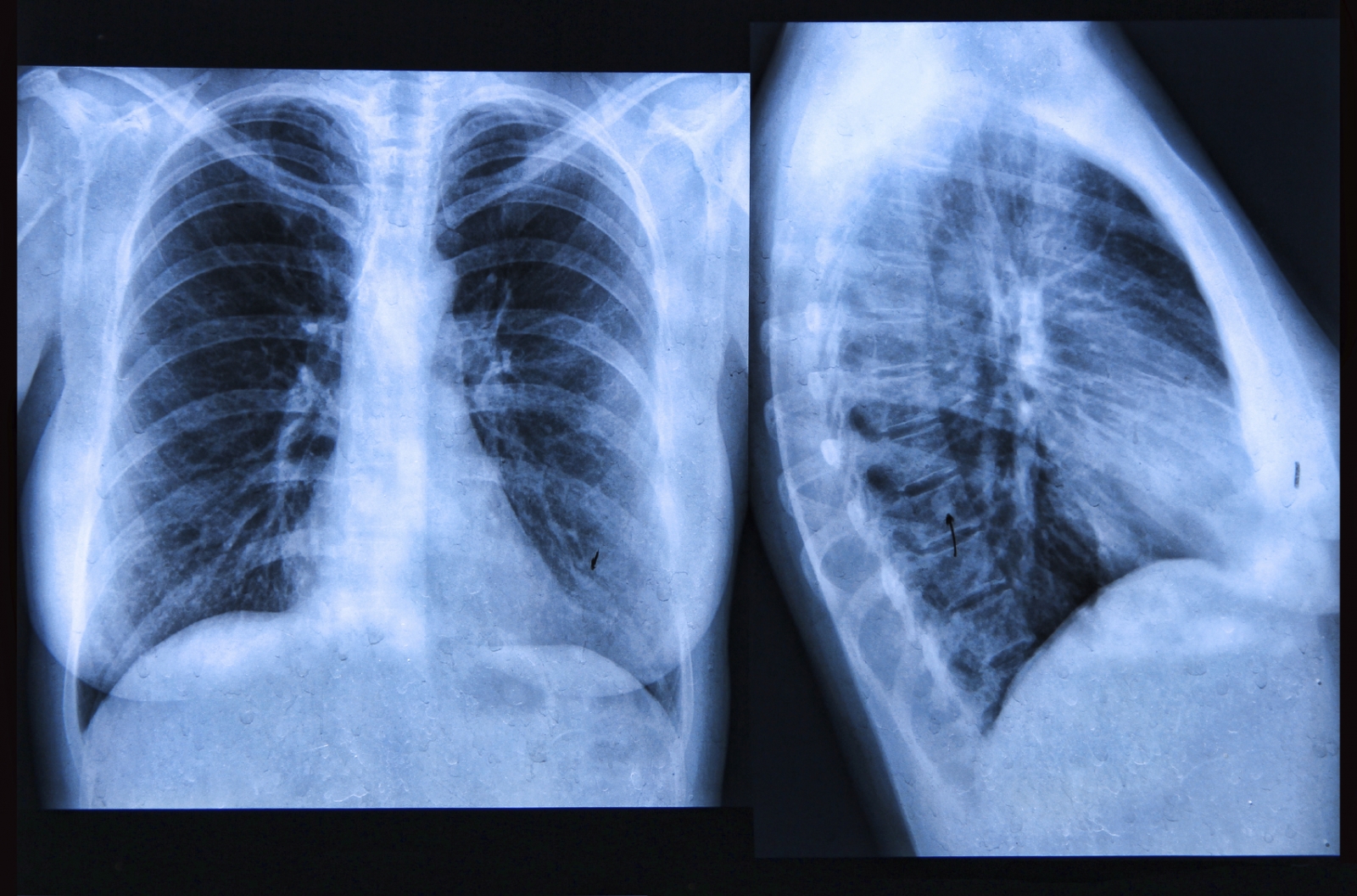 _中期肺纤维化X光图片_有来医生