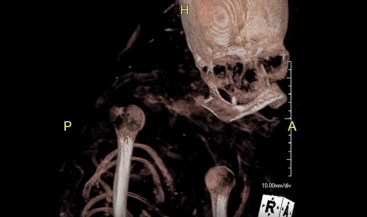 Brain Of 3,200-year-old Egyptian Mummy Hatason Revealed Through CT Scans