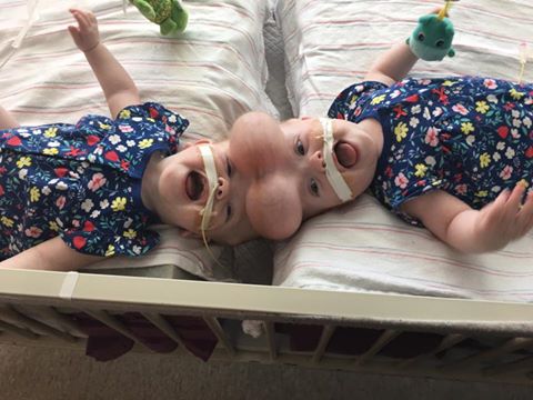 twins conjoined surgery separated girls head delaney abby erin craniopagus twin baby joined little heads babies their once life successfully
