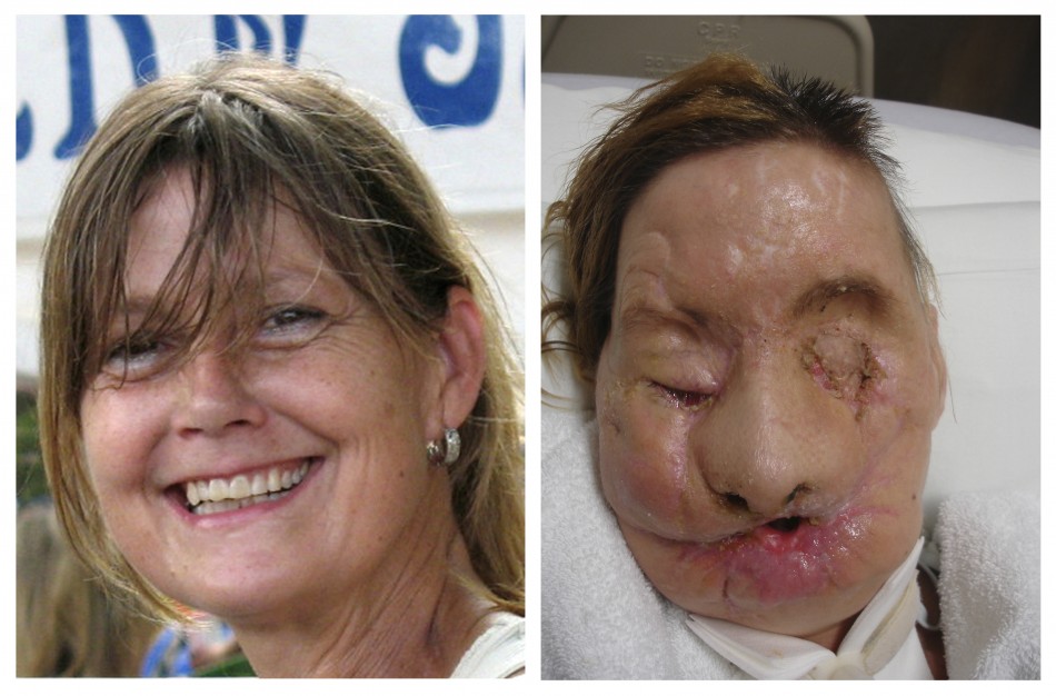 Charla Nash Wins $4m After Chimpanzee Ripped Her Face Off