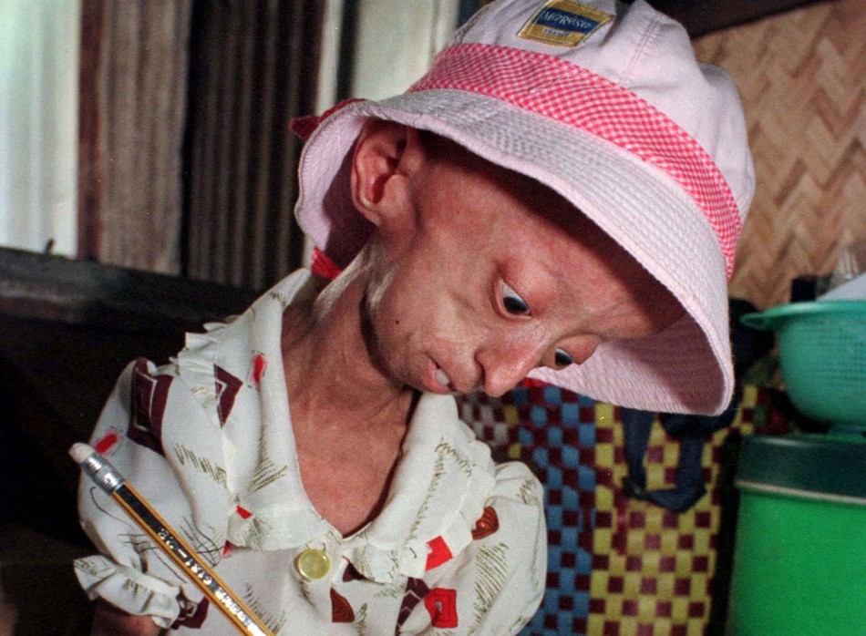 hutchinson gilford progeria syndrome