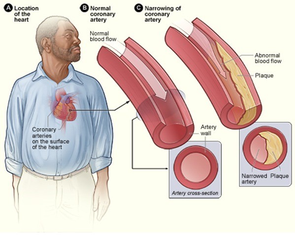 stroke medicinal drug remedy