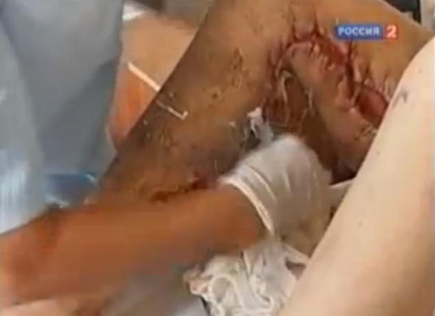 17-year-old injected krokodil into her genitals (1948ROSS/YouTube) 17-year-old injected krokodil into her genitals (1948ROSS/YouTube)