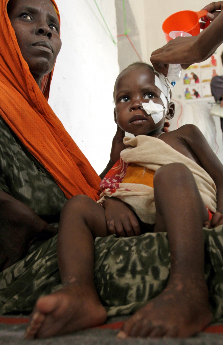 A malnourished child is fed using a naso-gastric tube at the therapeutic feeding centre run by Action contre la faim