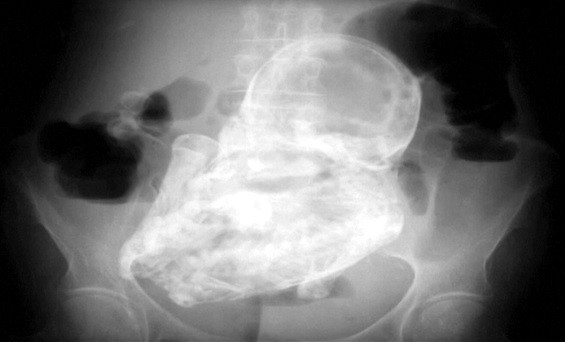 Stone baby was discovered inside an 82-year-old woman in Colombia