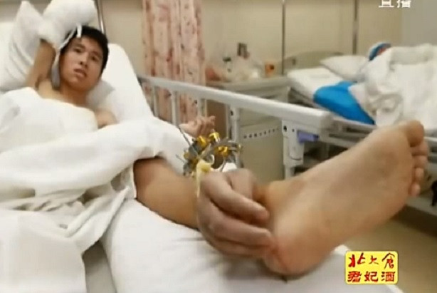 This Chinese labourer has lost a hand for now, but can still scratch a foot itch