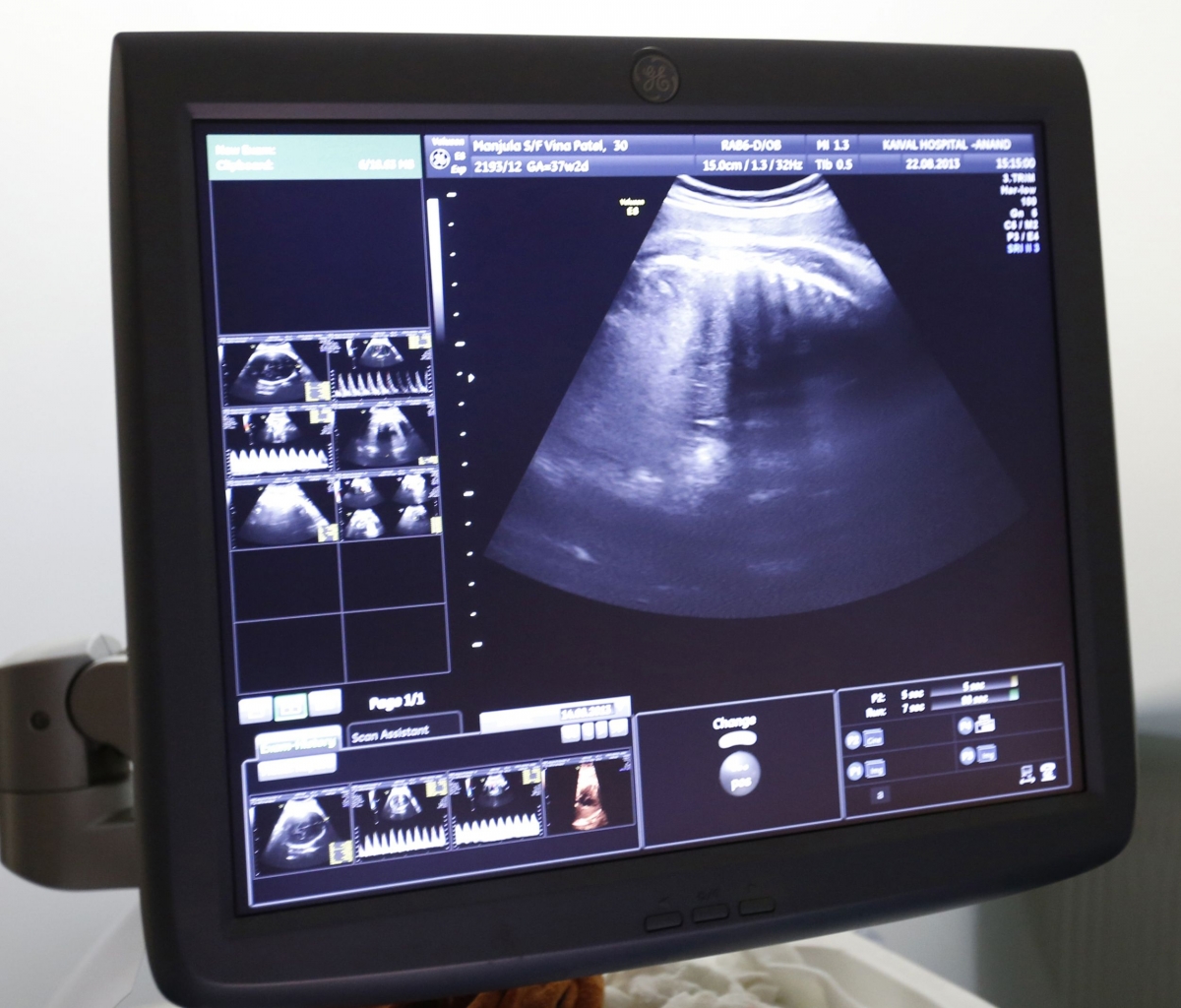 An ultrasound image of surrogate mother at an IVF centre in India. IVF's success rate could be doubled by screening of egg, say a new study. An ultrasound image of surrogate mother at an IVF centre in India. IVF's success rate could be doubled by screening of egg, say a new study.