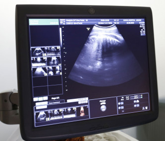 An ultrasound image of surrogate mother at an IVF centre in India. IVF's success rate could be doubled by screening of egg, say a new study. An ultrasound image of surrogate mother at an IVF centre in India. IVF's success rate could be doubled by screening of egg, say a new study.
