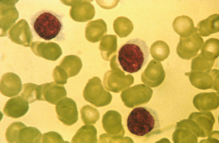 Hairy cell leukemia