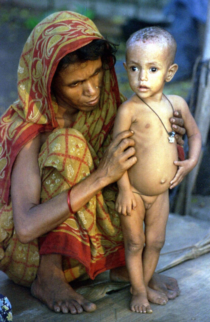 Hookworm infected child