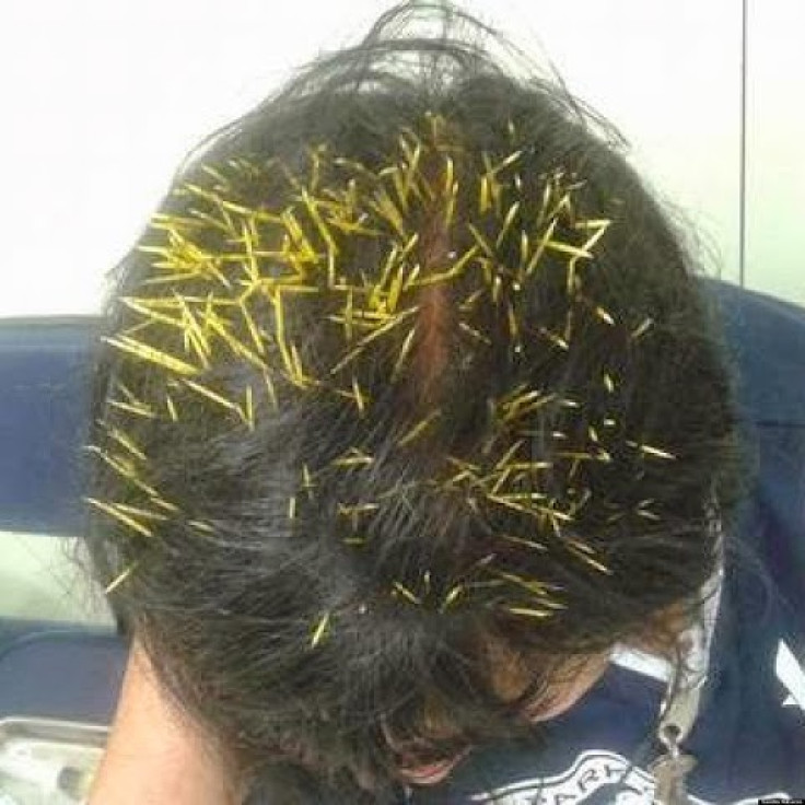 Porcupine quills embedded in the scalp of Sandra Nabucco