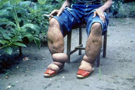 Swelling in elephantiasis cases occurs when parasites obstruct the lymph flow, leading to improper drainage of the lymph.