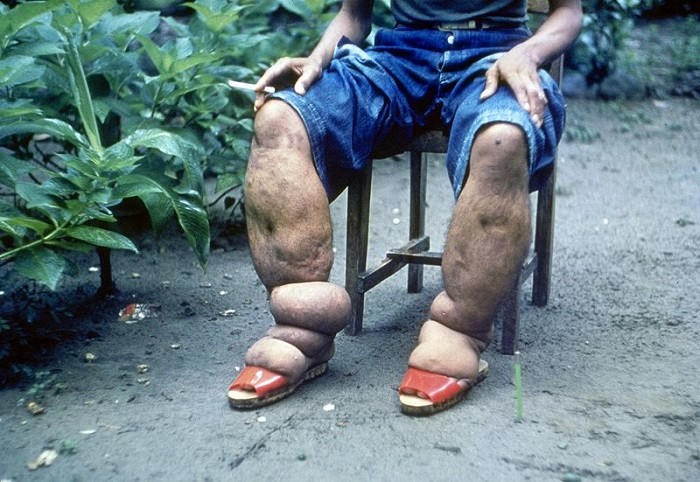 Swelling in elephantiasis cases occurs when parasites obstruct the lymph flow, leading to improper drainage of the lymph.