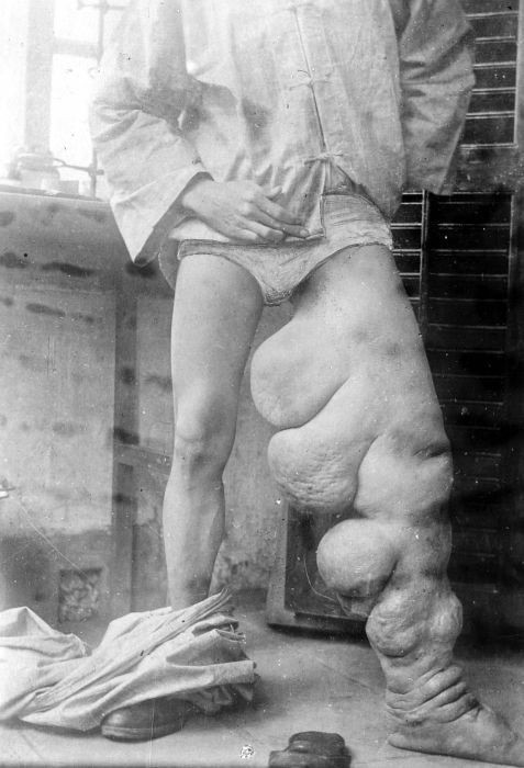 Lymphatic filariasis affects over 25 million men with genital disease and over 15 million people with lymphoedema.