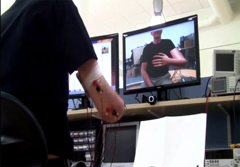 An amputee in Sweden tests a virtual reality game that can remove Phantom Limb pain