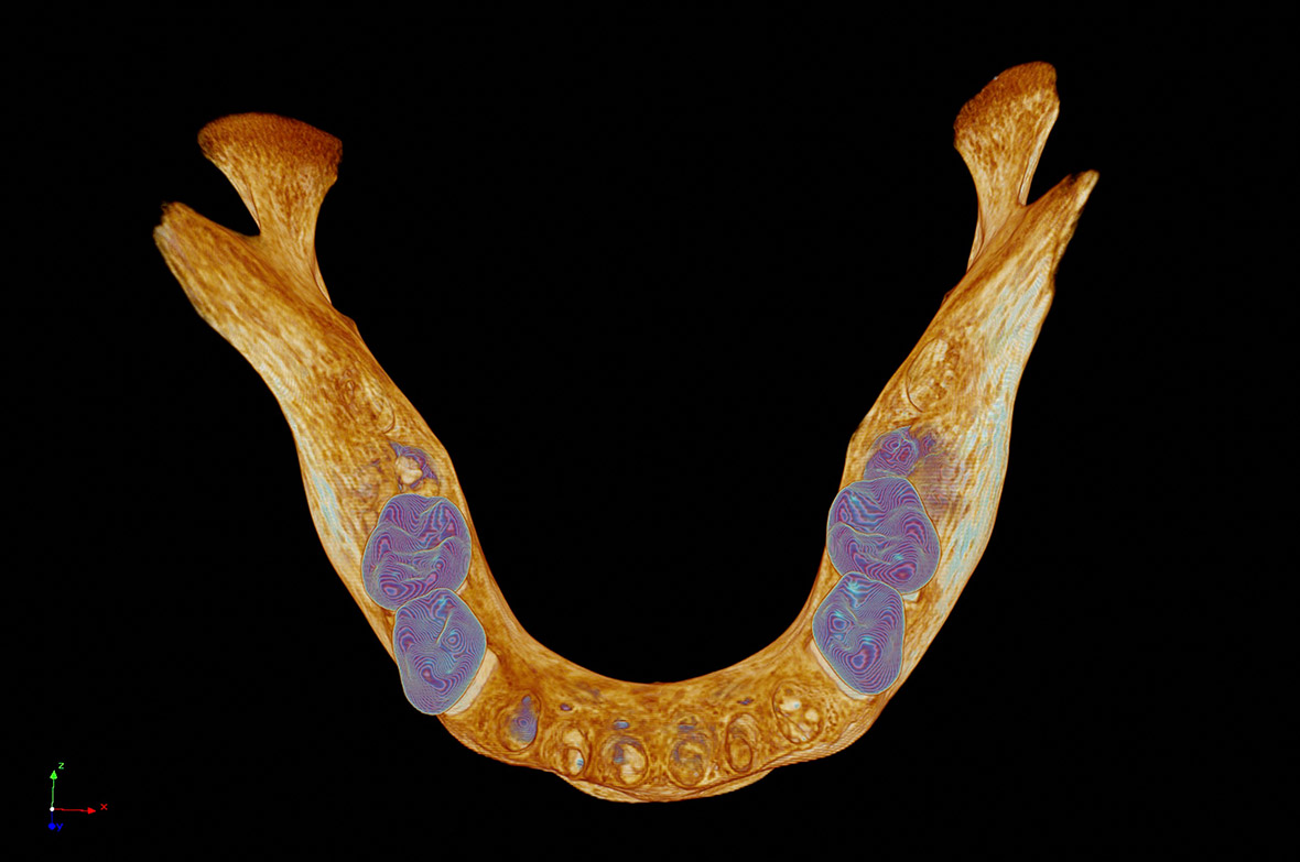 Medieval human mandible lower jawbone