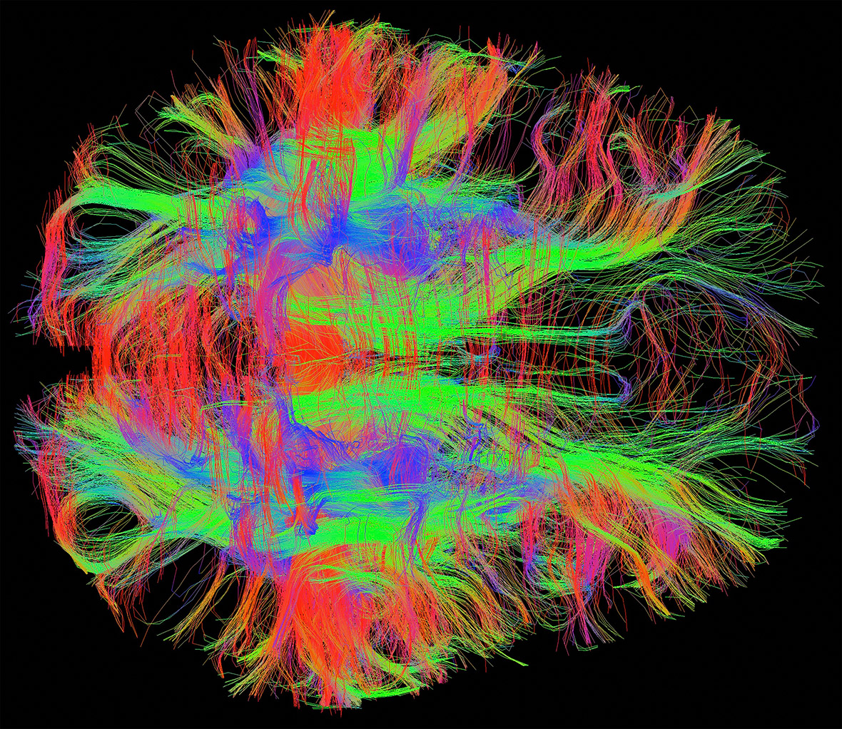 Nerve fibres in a healthy adult human brain, MRI