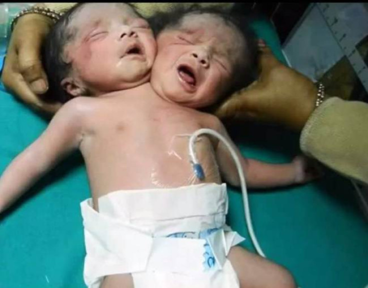 Baby with two heads born in India