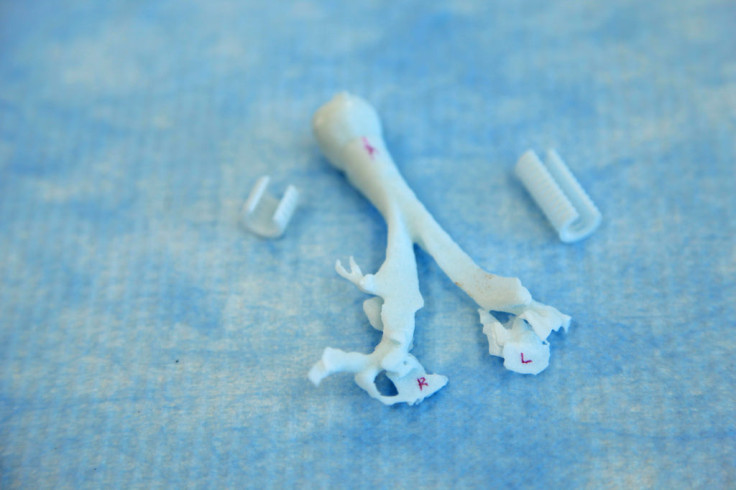The 3D-printed splint that can open a baby's airways