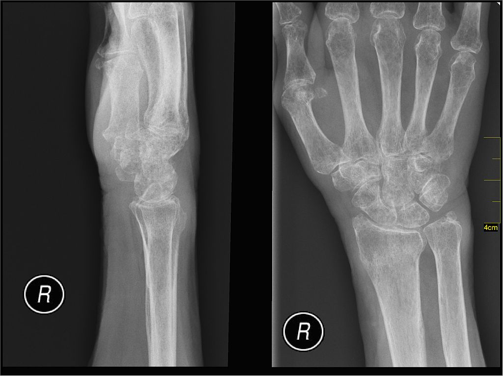 Protective Goo Inside Bones Prevents Shattering Under Pressure