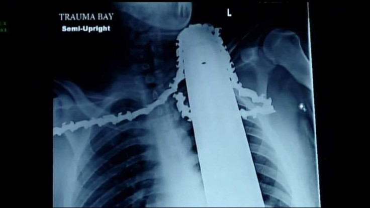 X Ray shows in graphic detail how the chainsaw embedded itself in Jame Valentine's upper body