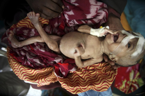 An internally displaced woman holds her malnourished son at the Banadir hospital in Somalia's capital Mogadishu
