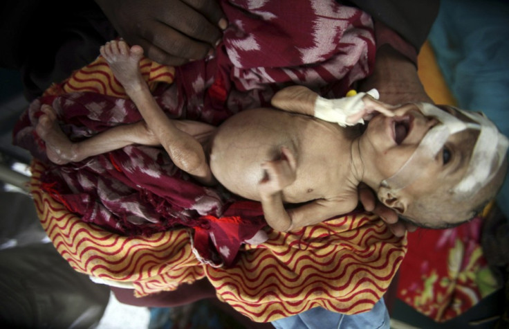 An internally displaced woman holds her malnourished son at the Banadir hospital in Somalia&#039;s capital Mogadishu