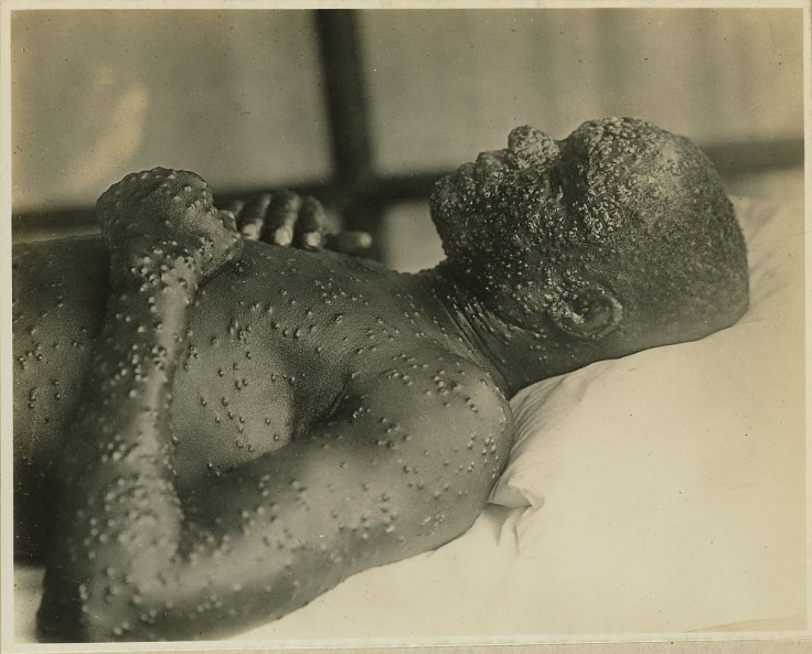 smallpox