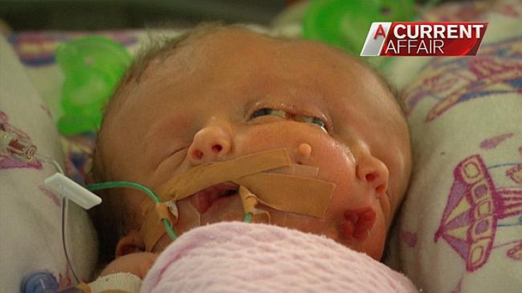Sydney: Miracle Twin Babies Faith and Hope Born with Two Faces on One Skull