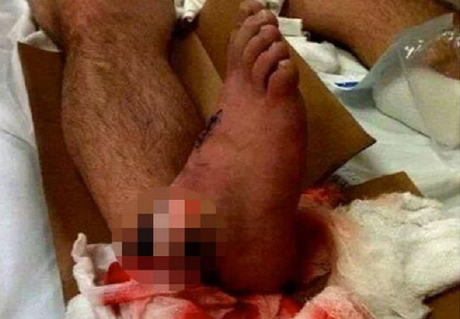 Blyth Town FC horror injury picture which shocked Twitter has been exposed as a fake