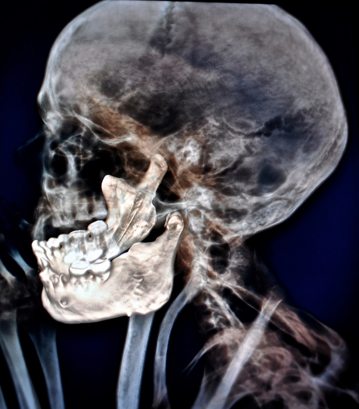 The CT scan reveals the state of dental decay in the mummy