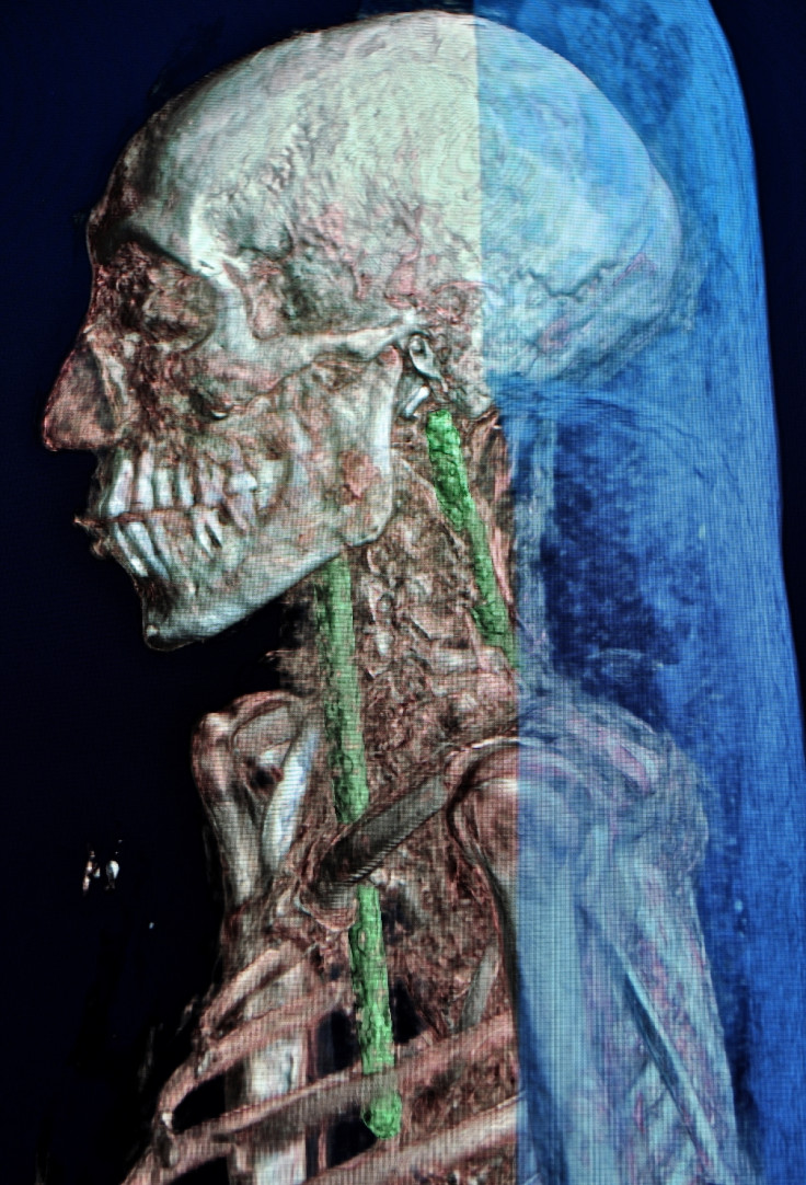 The CT scan shows ancient repairs of rods inserted into the skull to keep the head attached to the body