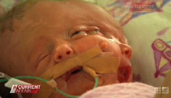 australia-s-miracle-conjoined-twins-faith-and-hope-lose-battle-for-life