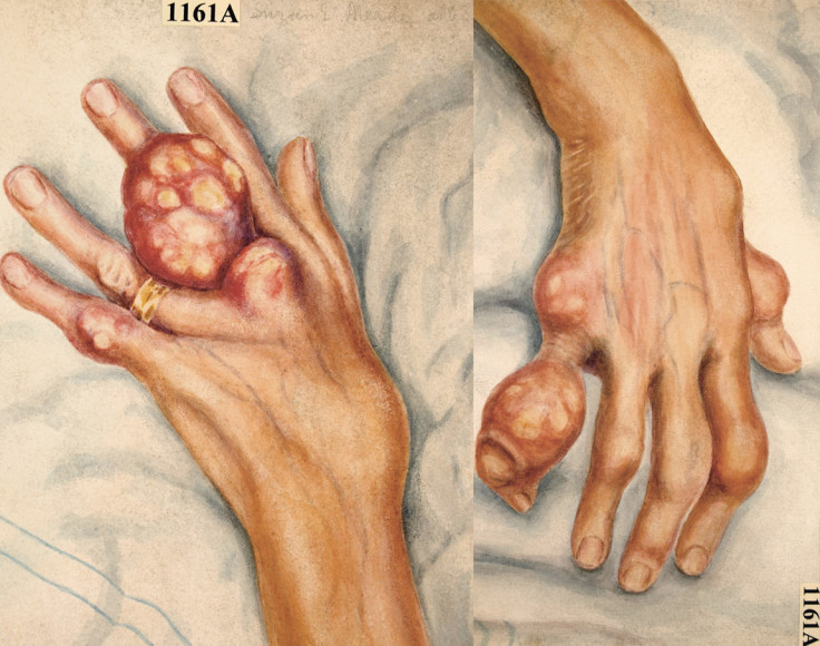 Sick Rose: Watercolour drawing of the hands of a sixty-three year old woman suffering from chronic gout