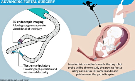 A robotic probe inserted into the womb will take 3D images A robotic probe inserted into the womb will take 3D images