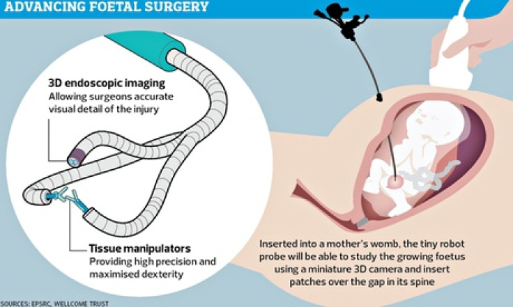 A robotic probe inserted into the womb will take 3D images