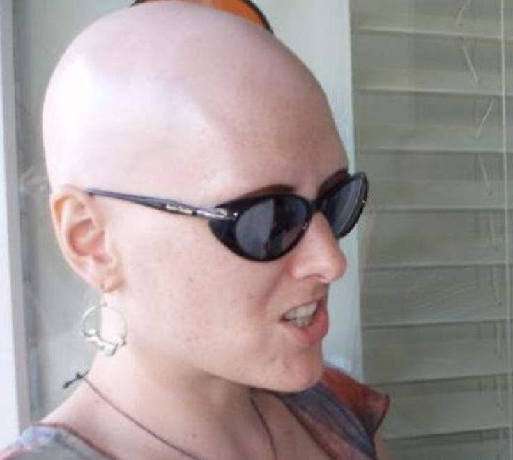 alopecia