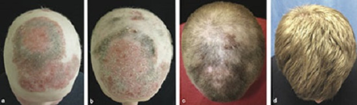 alopecia