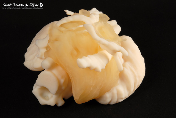 The 3D model of the tumour, surrounded by blood vessels and arteries The 3D model of the tumour, surrounded by blood vessels and arteries