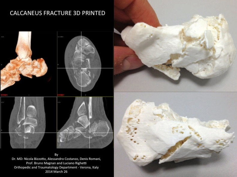 A 3D-printed replica of a complex fracture in the foot