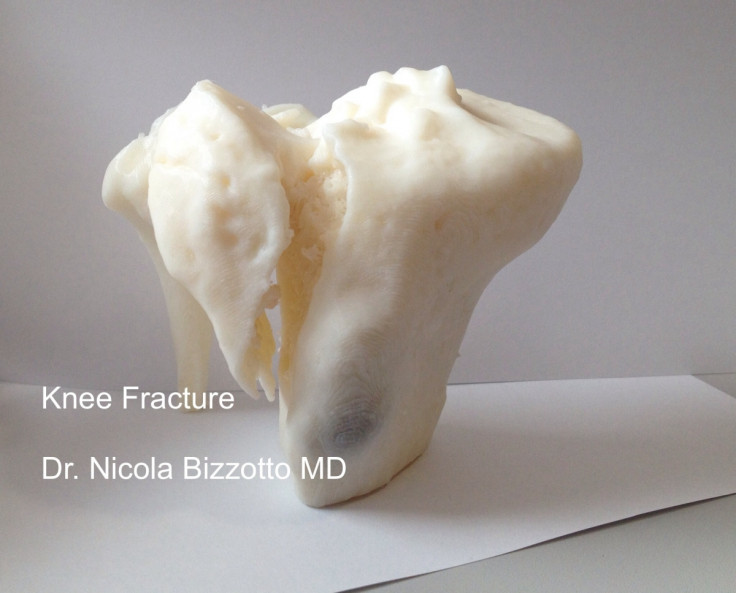 A 3D-printed knee bone fracture