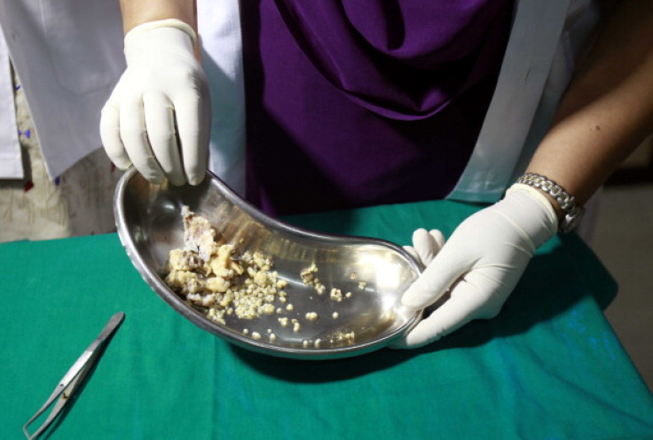 Indian teen getting his 232 teeth pulled out in Mumbai