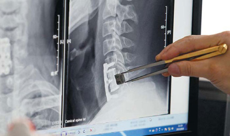 Making sure the 3D-printed vertebra implant matches the vertabra in the patient's neck