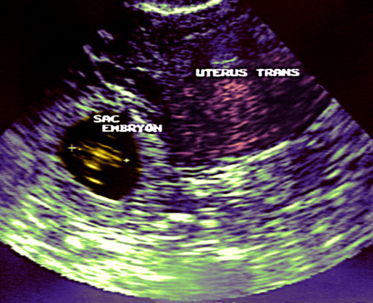 Sonogram showing an ectopic pregnancy