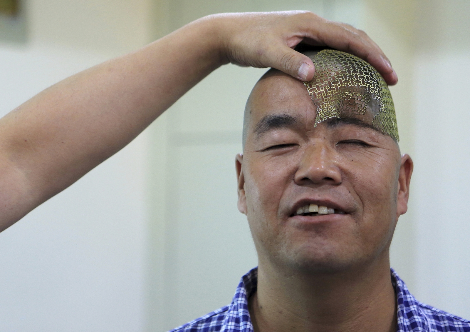 A Chinese man with only half a skull has undergone pioneering surgery to implant a titanium mesh into his head A Chinese man with only half a skull has undergone pioneering surgery to implant a titanium mesh into his head