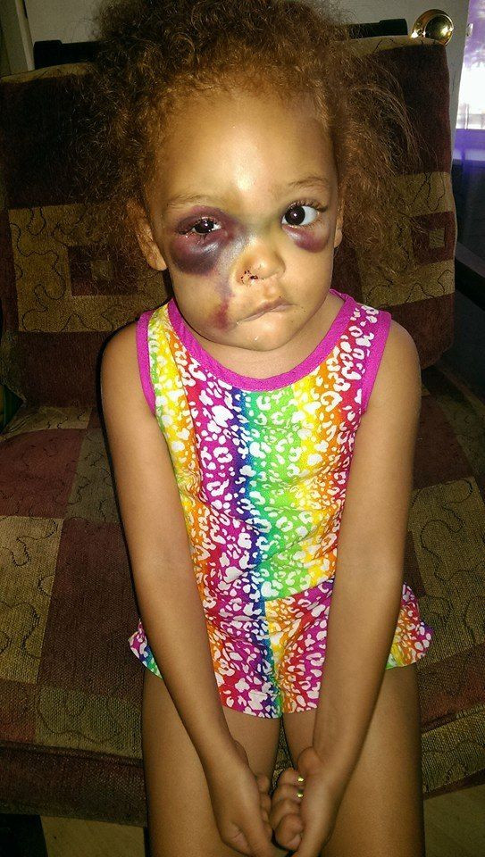AvaLynn injuries