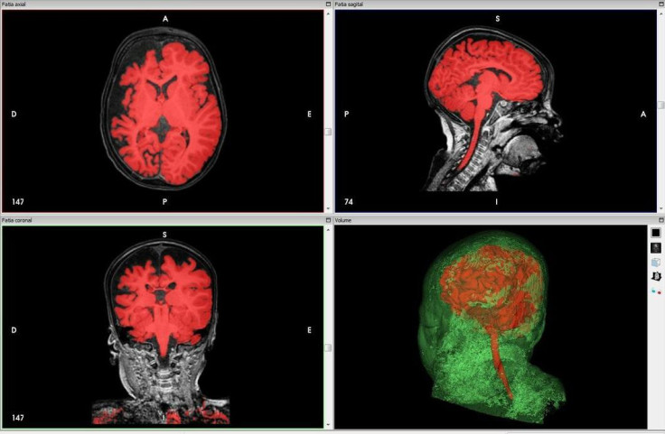 The CT scan of an infant suffering from Sturge-Weber syndrome